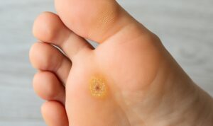 Plantar warts